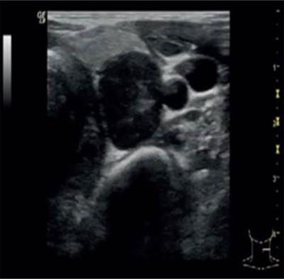 Parathyroid Carcinoma All-In-One, a Rare Life-Threatening Case With Multiple Systemic Manifestations: Case Report and Review of the Literature